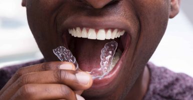 Close-up Of A Man Adjusting Transparent Aligners In His White Teeth